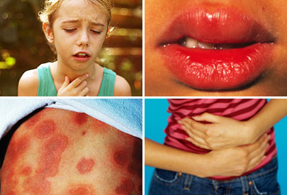 Симптомы аллергии